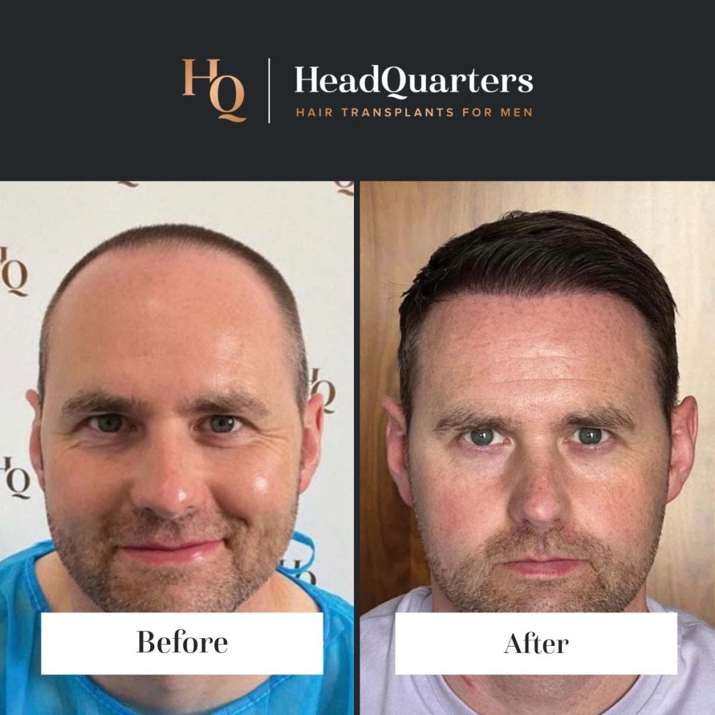 https://hqhairtransplants.com/wp-content/uploads/2024/07/hair-transplant-before-and-after-template-2-12-1024x1024.jpg