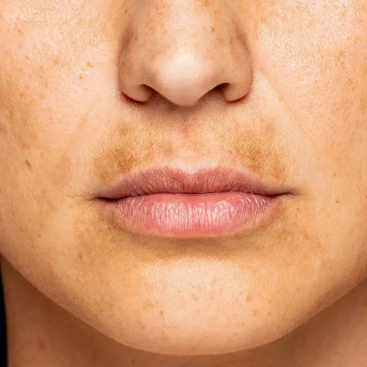 Best Uneven Skin Tone Treatments Dublin | Laser + Skin Clinics