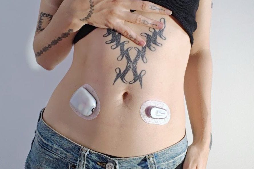 A photo of a woman wearing an insulin patch pump and a cgm sensor on her stomach. The insulin pump is a small white pod on one side and the sensor is a smaller oval shape on the other side. They are stuck to the skin with adhesive. She has a number of tattoos and is wearing jeans and a black crop top A photo of a woman wearing an insulin patch pump and a cgm sensor on her stomach. The insulin pump is a small white pod on one side and the sensor is a smaller oval shape on the other side. They are stuck to the skin with adhesive. She has a number of tattoos and is wearing jeans and a black crop top