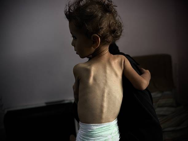 Fourteen-month-old Hazar Arfa, receiving treatment at Nasser Hospital in Khan Yunis in southern Gaza, is in critical condition due to severe...