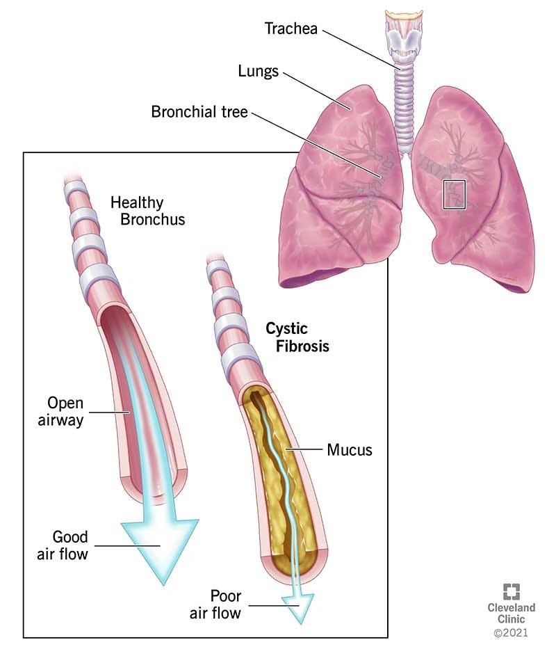 Cystic Fibrosis (CF): Causes, Symptoms, Diagnosis & Treatment