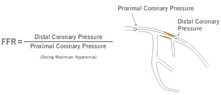 Fractional Flow Reserve (FFR) – CathLab.com