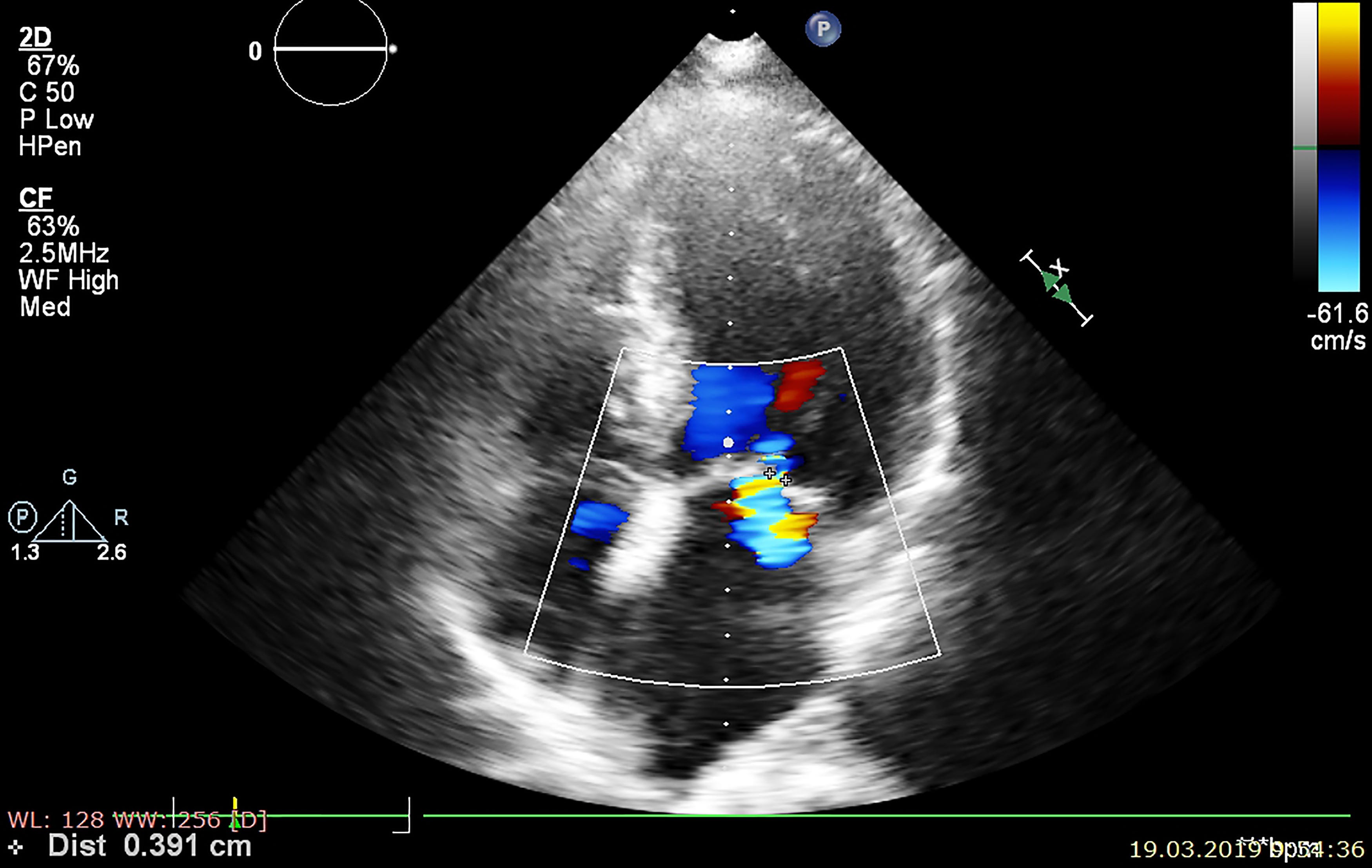 Grayscale echocardiogram with Doppler flow indicating turbulent flow