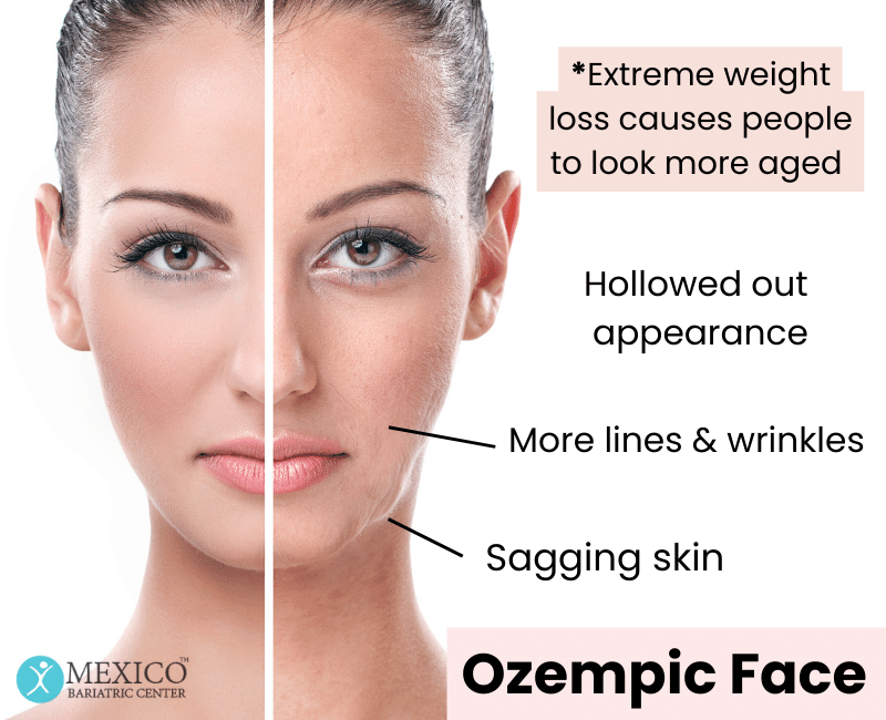 https://mexicobariatriccenter.com/wp-content/uploads/2023/07/Ozempic-Face-.png https://mexicobariatriccenter.com/wp-content/uploads/2023/07/Ozempic-Face-.png