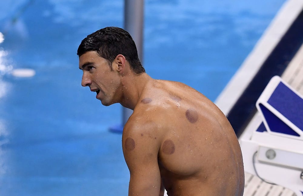 Test Drive: I tried cupping therapy, and I actually liked it - Atlanta  Magazine