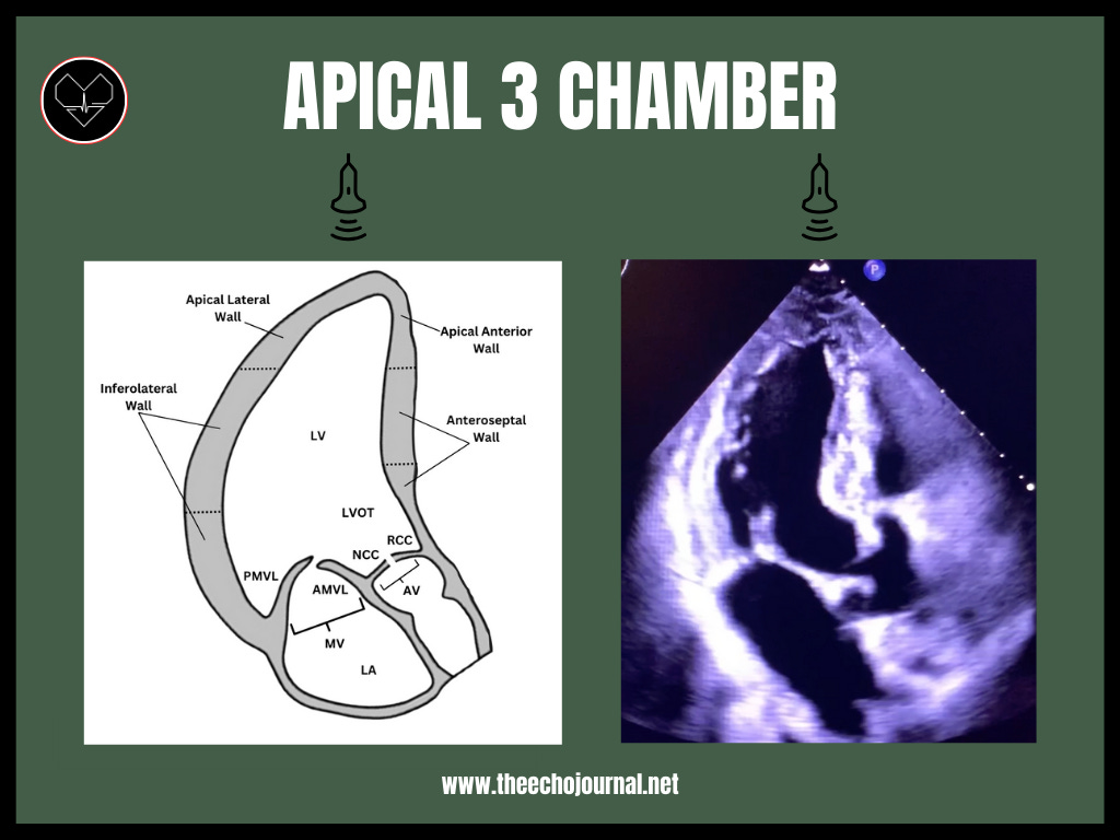 Apical 2 and 3: Acquisition, Angles, and Accuracy