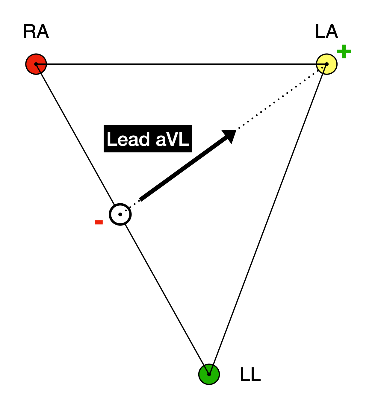 Einthoven's triangle with RA (red), LA (yellow), and LL (green) at the vertices. A small hollow circle sits on the side connecting RA and LL, at its midpoint, marked with a red minus sign. A black arrow runs from this midpoint up to the LA electrode, which is marked with a green plus sign. The arrow is labelled Lead aVL.