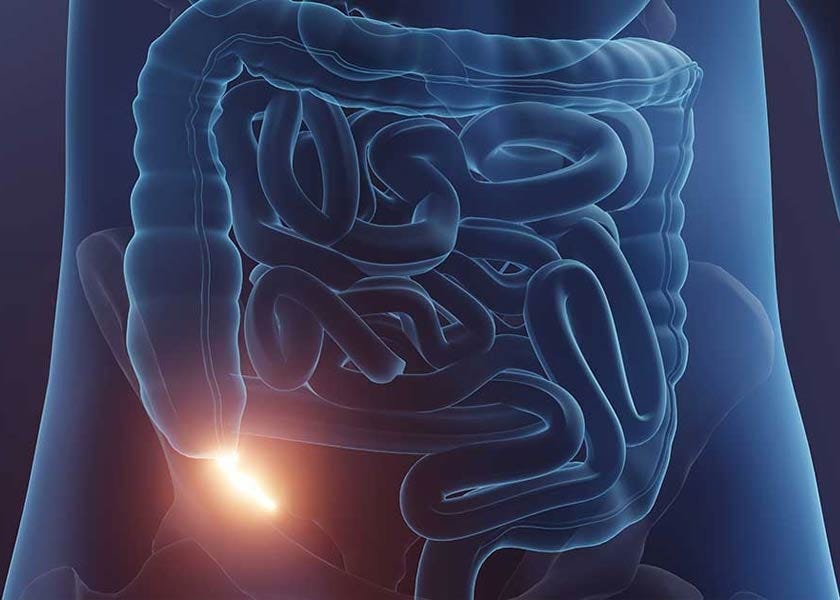 Sub Appendix Appendix Cancer Is on the Rise Among Younger Generations