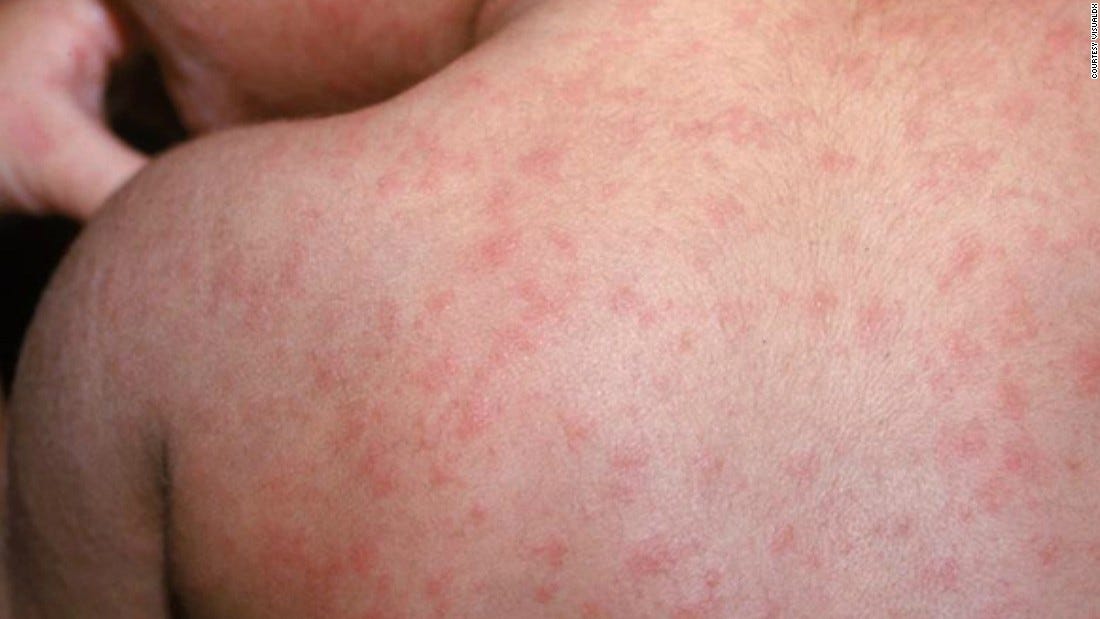 Latest updates: Measles is spreading across the US