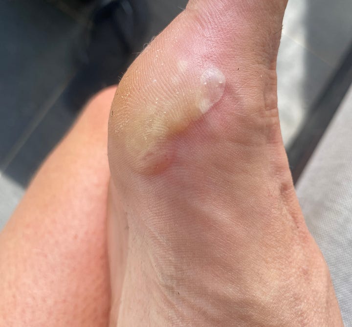 blisters forming on the side of the foot