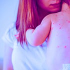 Texas Gave 15,000 More MMR Shots This Year—Now It Has More Measles Cases Than the Entire U.S. Had in 2024