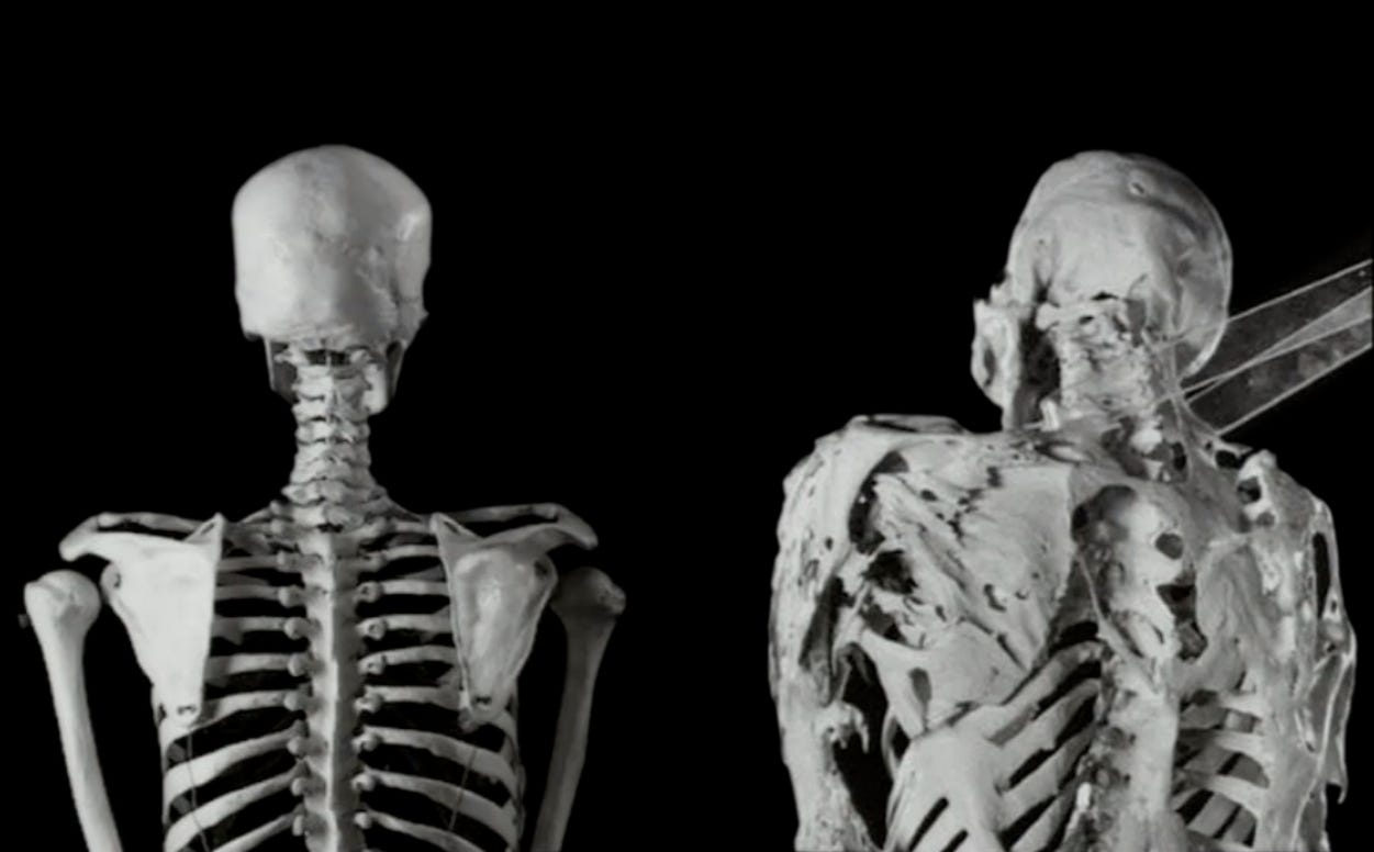 Fibrodysplasia Ossificans Progressiva (FOP) Case Study - UCSF MedConnection