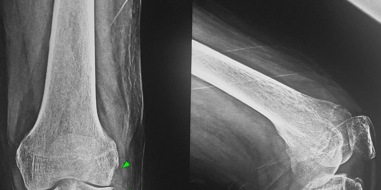 Case 65: Mono-articular Knee Arthropathy