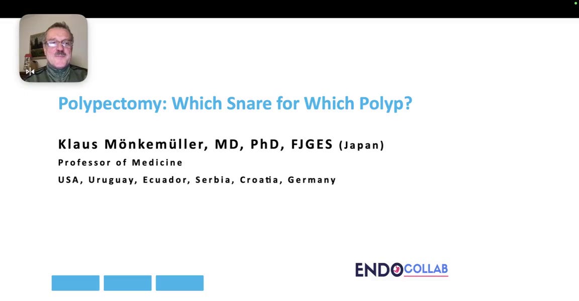 Polypectomy: Which Snare for Which Polyp?