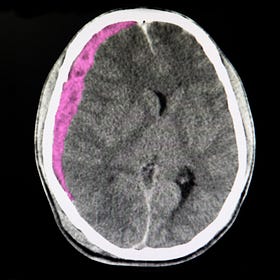Middle meningeal artery embolization for subdural hematoma