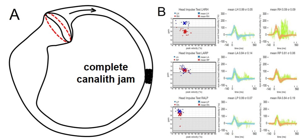 Complete and Incomplete Canalith Jam: Diagnosis of Atypical Variants of  BPPV and Key Roles of Video-HIT - Interview 28669