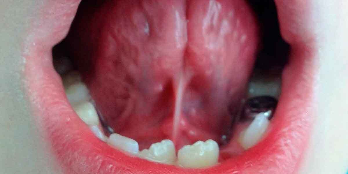 Tongue Tie Treatment in Brooklyn 11229 - Eco Dental NY - Dentist in  Brooklyn 11229