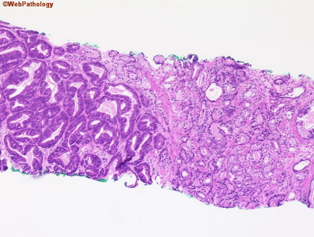 Microscope photo: On the left, cells are large and heavily outlined as if wearing mascara. On the right cells are almost pinholes. Microscope photo: On the left, cells are large and heavily outlined as if wearing mascara. On the right cells are almost pinholes.