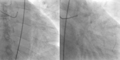 GIF de uma revascularização. No lado esquerdo, a imagem mostra as artérias obstruídas, sem passagem de sangue. Na direita, após a angioplastia com stent, fluxo de sangue continua normalmente.