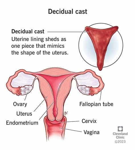 decidual cast 