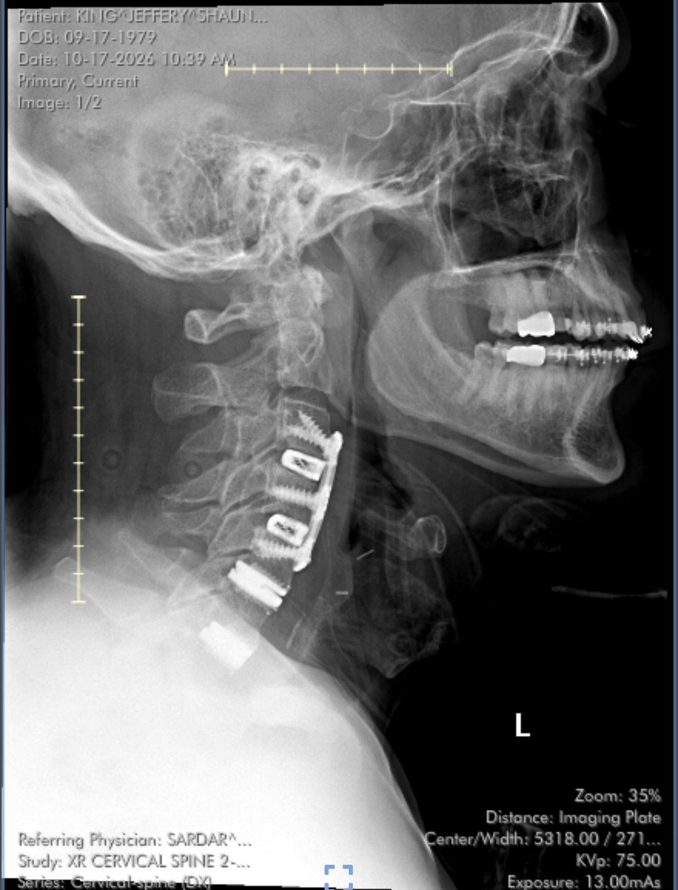 Spine Sign Fast I can't believe my spine looks like that!