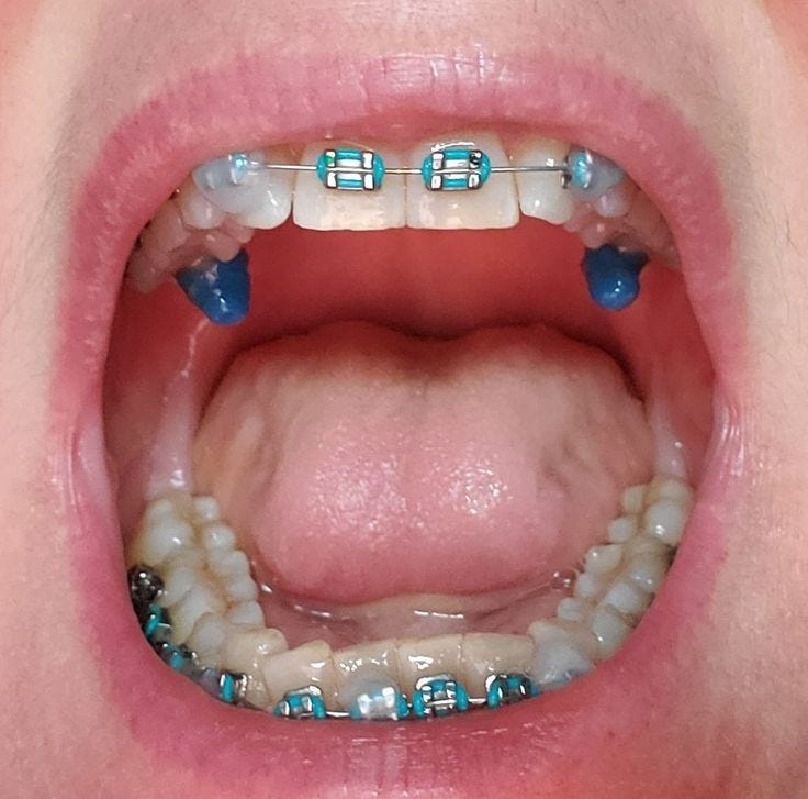 How Effective Are Bite Turbos?