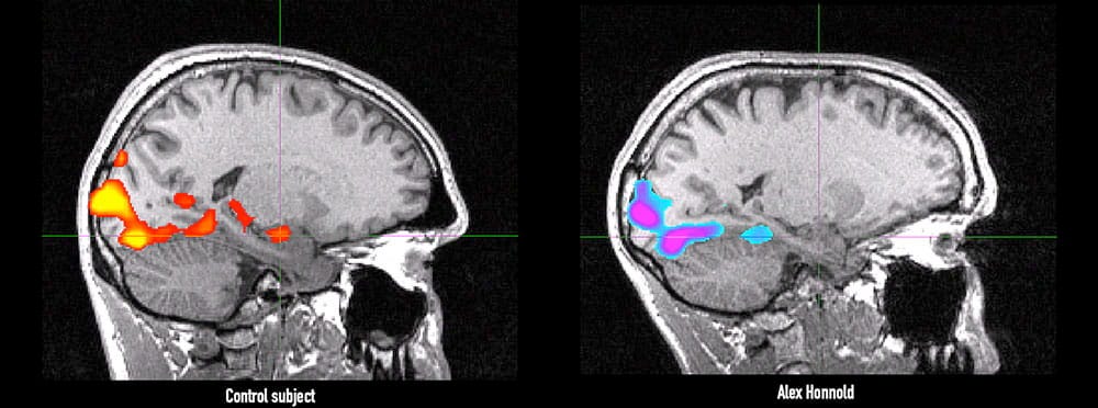 Side by side images of Alex Honnold's brain and a control subject