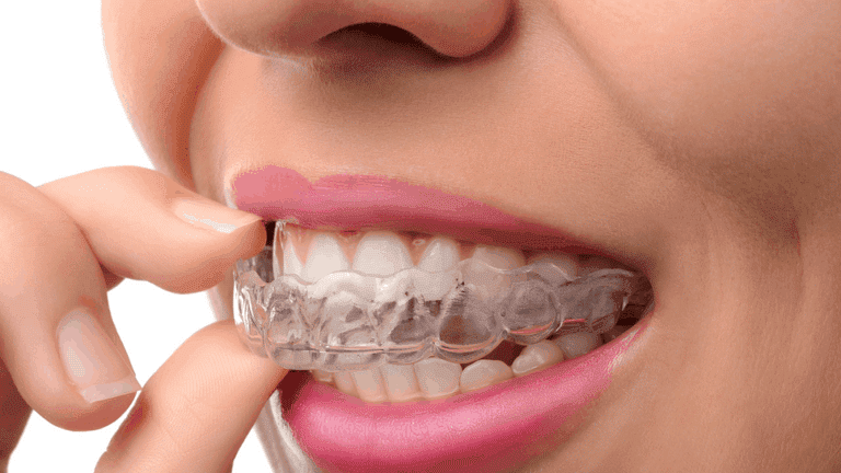 How Clear Teeth Aligners are Made: A Comprehensive Guide