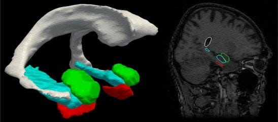 Left: surface reconstruction of amygdala (green), entorhinal cortex ...
