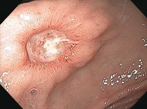 Endoscopy-Gastric-Ulcer | Dr. Alexander Mantas - Gastroenterologist in  Dallas TX