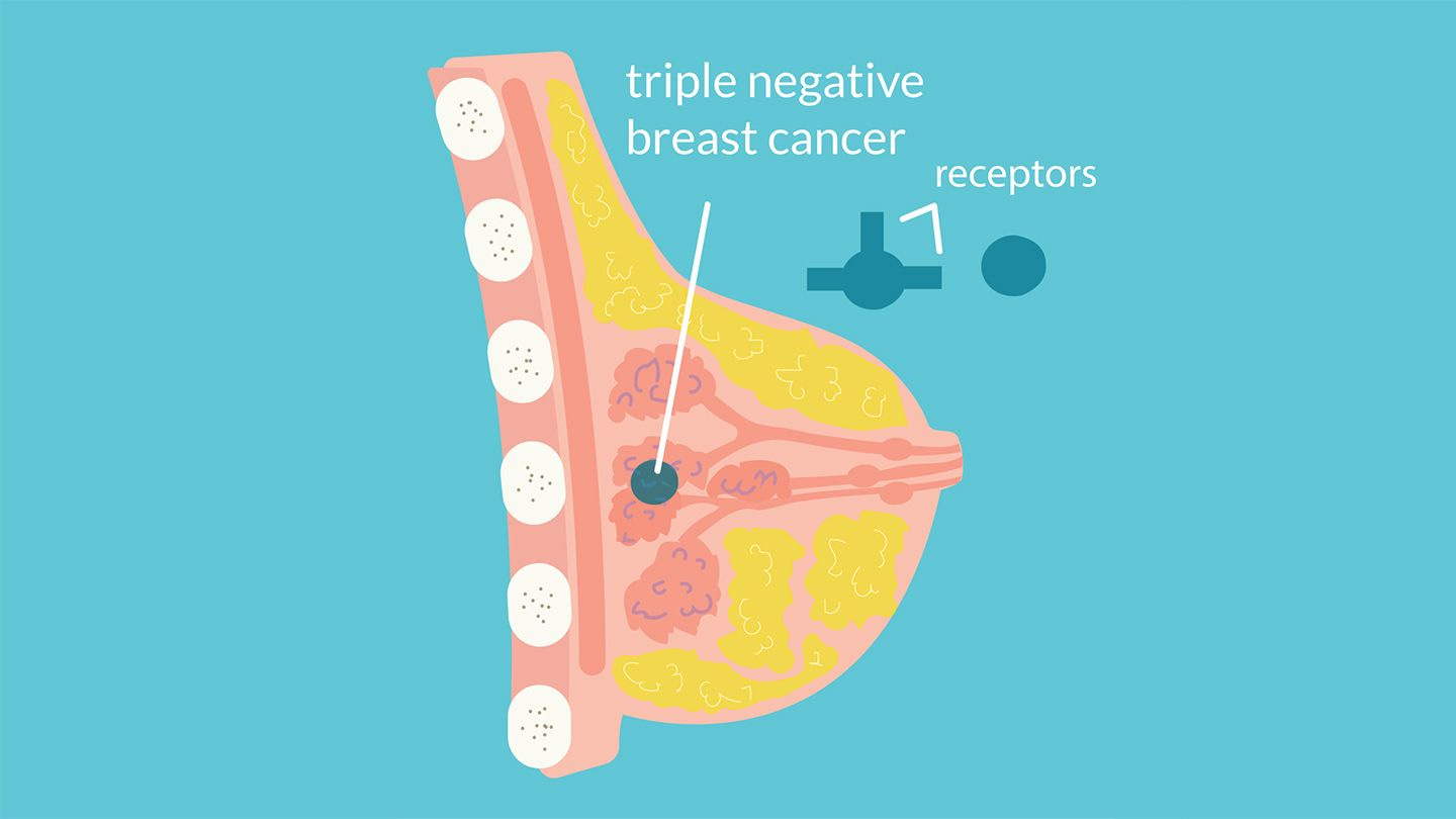 What Is Triple-Negative Breast Cancer? Symptoms, Treatment, and More What Is Triple-Negative Breast Cancer? Symptoms, Treatment, and More