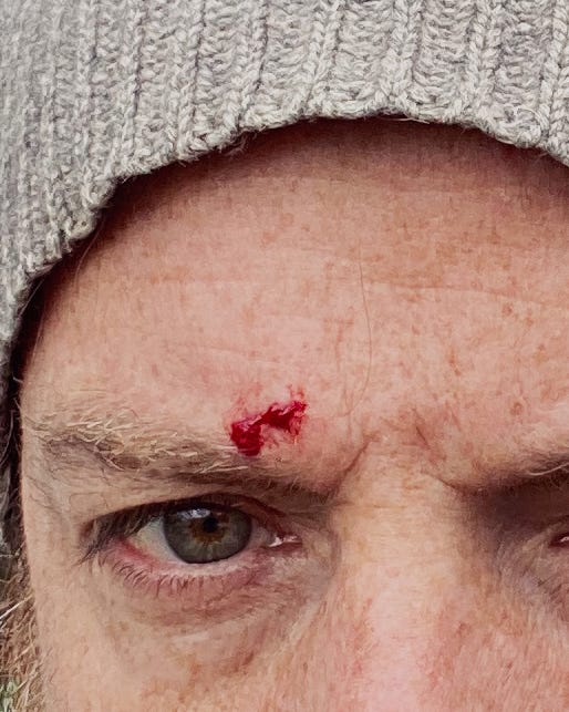 Cut on forehead