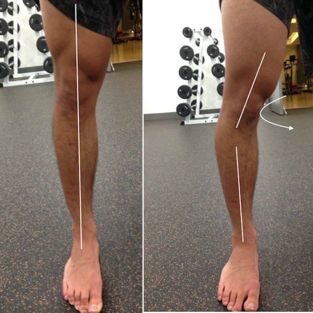 Bow legs in adults caused by foot mechanics showing how therapeutic insoles correct leg alignment
