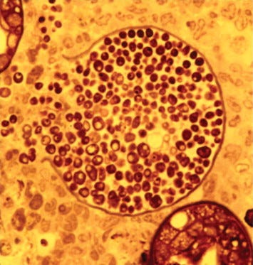 Coccidioides posadasii - an overview | ScienceDirect Topics