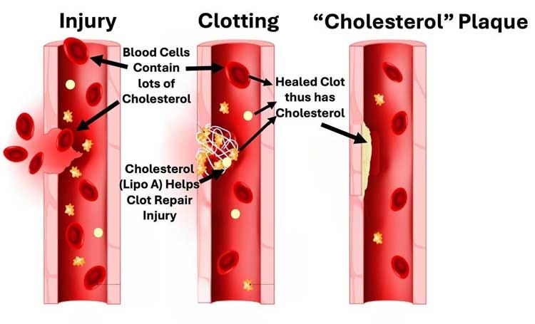 causes of heart disease