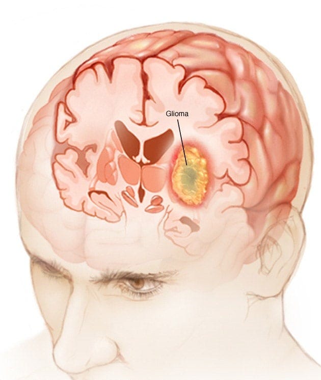 Glioma - Symptoms and causes - Mayo Clinic