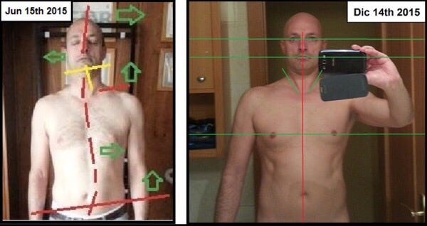 Dystonia: Experience in Biomechanical Treatment - tooth-for-a-tooth.com