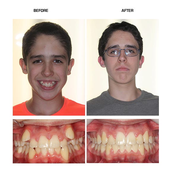Smile Transformations: Before & After – Niepraschk Orthodontics