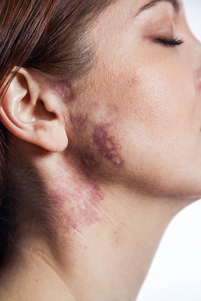 Beautiful Woman With Portwine Stain On Her Face Stock Photo - Download  Image Now - iStock