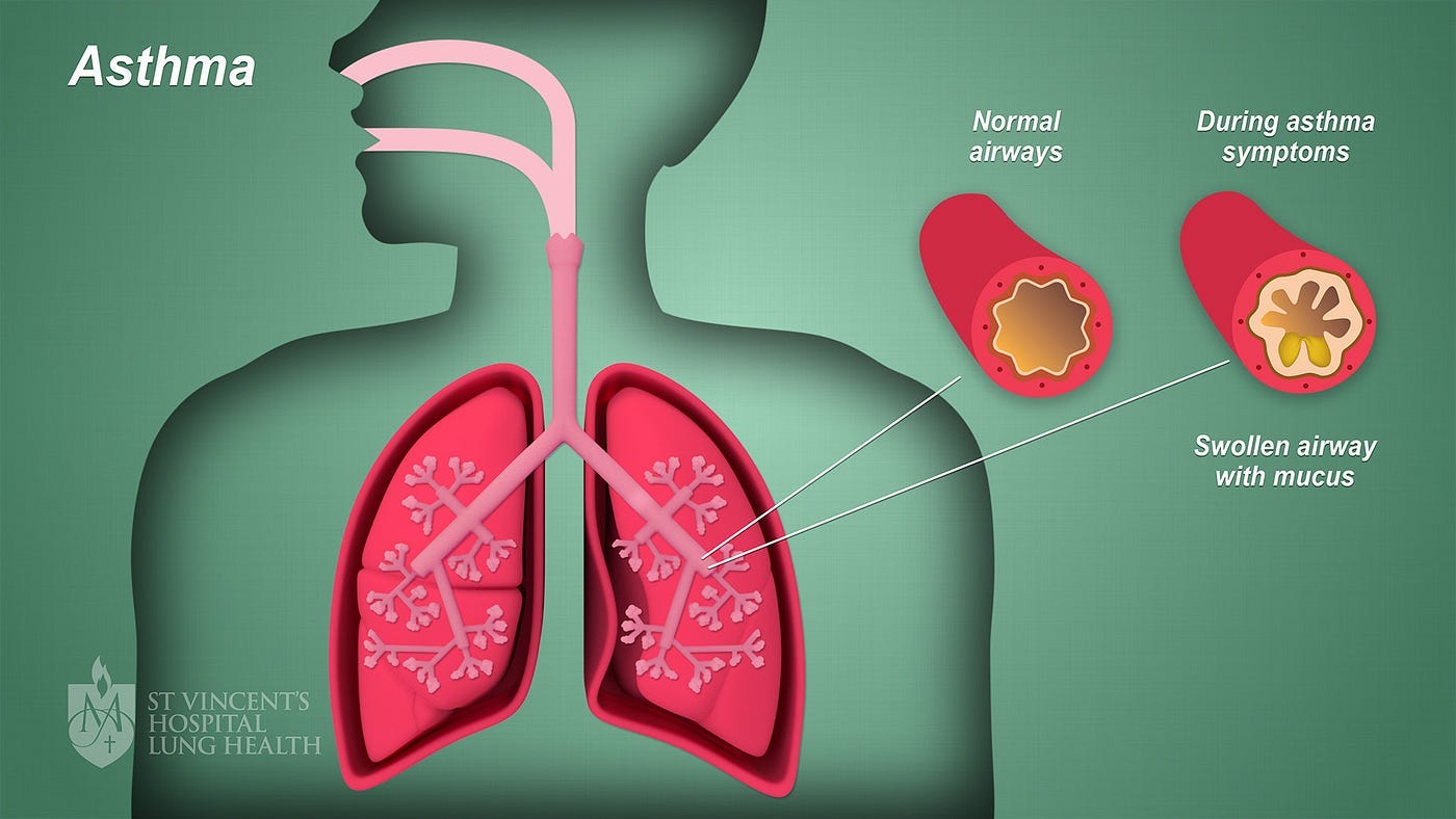 St. Vincent’s Hospital Lung Health
