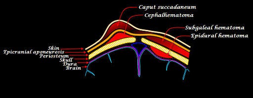 Scalp hematomas Scalp hematomas