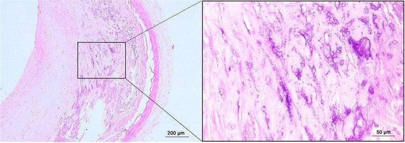 File:Histopathology of a fibrocalcific atheroma.jpg File:Histopathology of a fibrocalcific atheroma.jpg