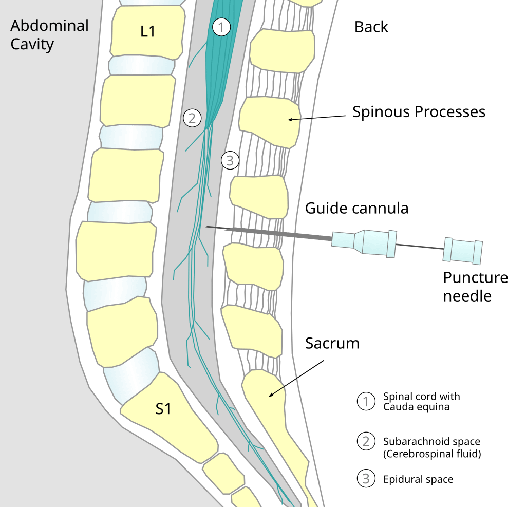 Spinal Stacking What Actually Happens During a Spinal (and an Epidural)?