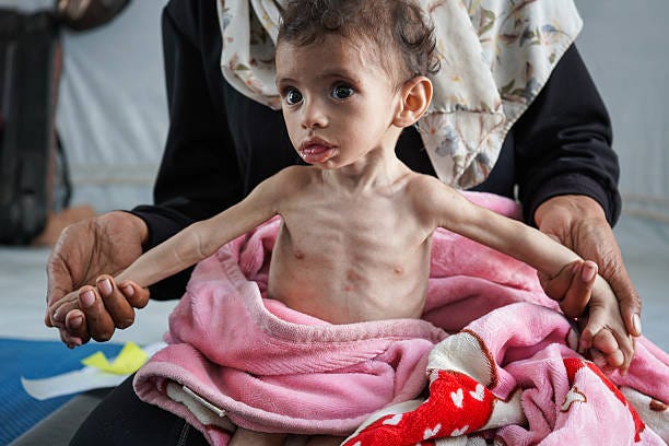 Eleven-month-old Zakaria El-Mabhuh, one of hundreds of children diagnosed with malnutrition, is seen as Israel's ongoing air and ground operations,...