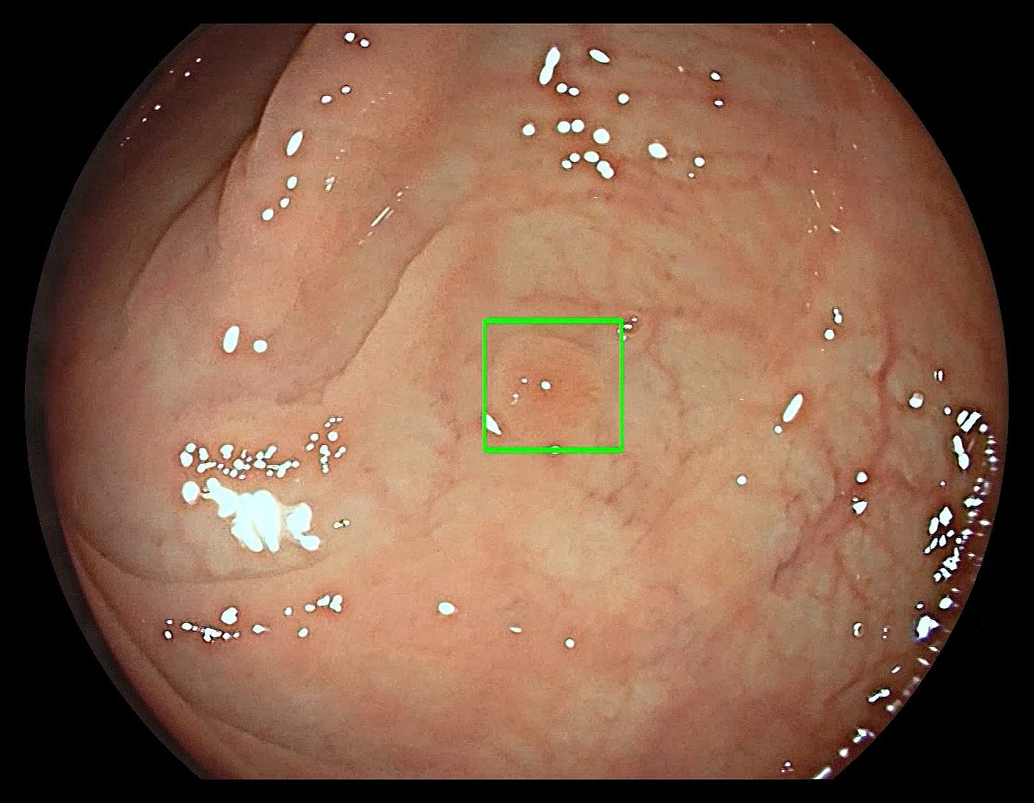 FDA Grants de novo Clearance for First AI-based CADe System for Colorectal  Polyps | Applied Radiology