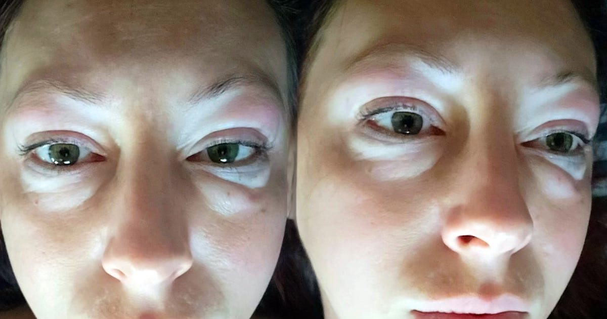 Close up of swollen eyes from severe food intolerances and MCS multiple chemical sensitivity in a woman.