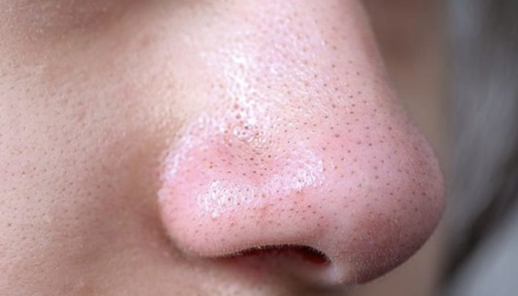 How to remove sebaceous filaments