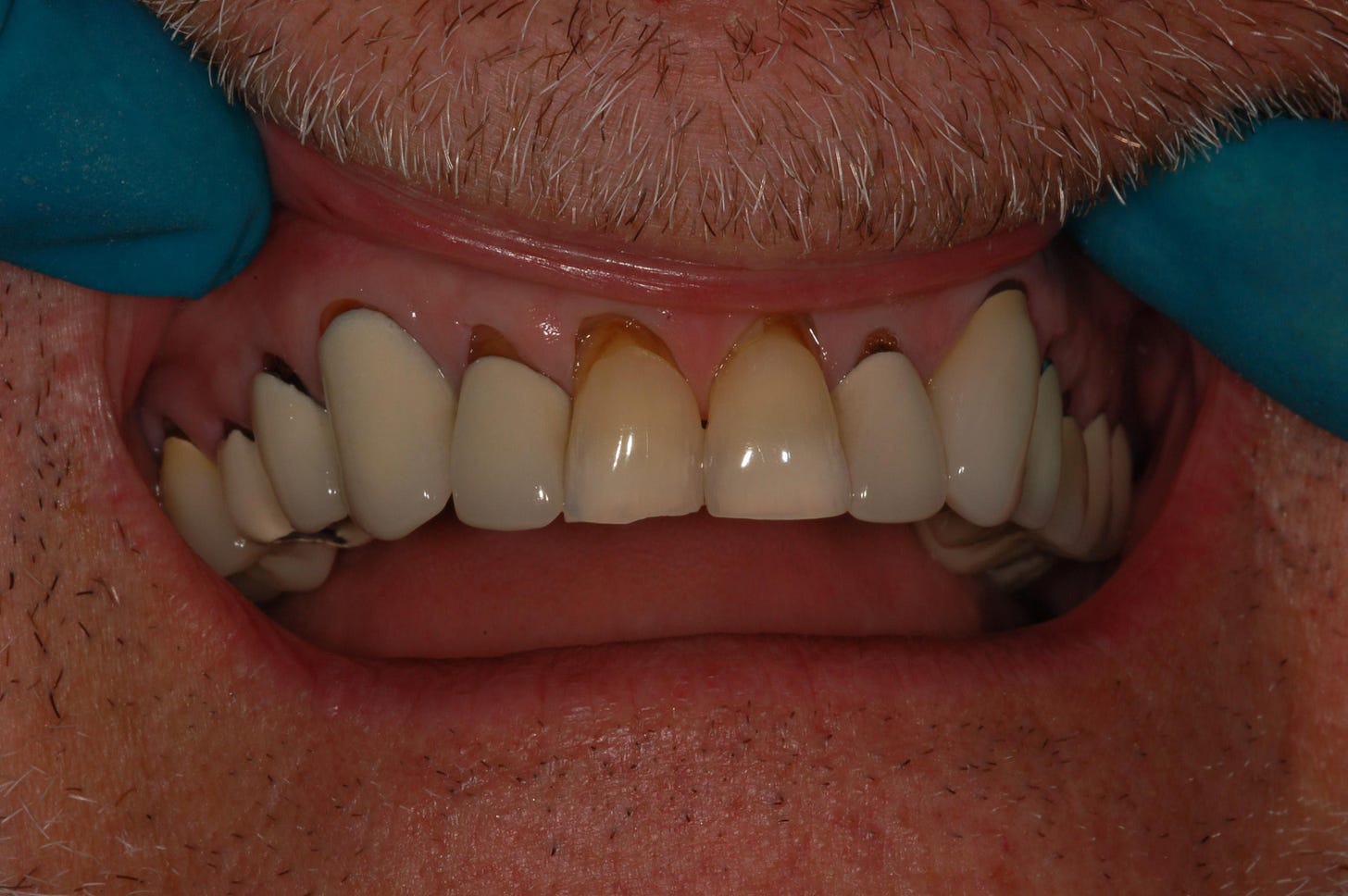 Mouth breather - Long in the tooth - common dental phrases