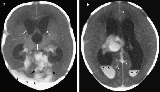 Newborn infant brain CT scan