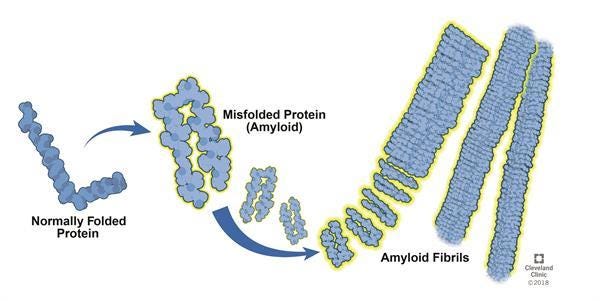 AL Amyloidosis (Primary Amyloidosis): Symptoms, Treatment & What it Is AL Amyloidosis (Primary Amyloidosis): Symptoms, Treatment & What it Is